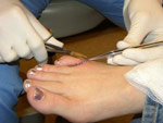 natural healing with acupuncture reduces surgery pain